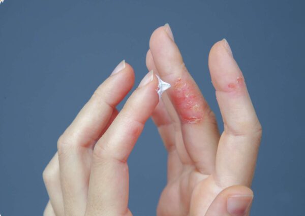 Eczema Treatment for Better Skin